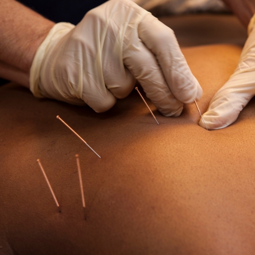 dry-needling-Park-Physiotherapy-and-Foot-Clinic-Oshawa-ON